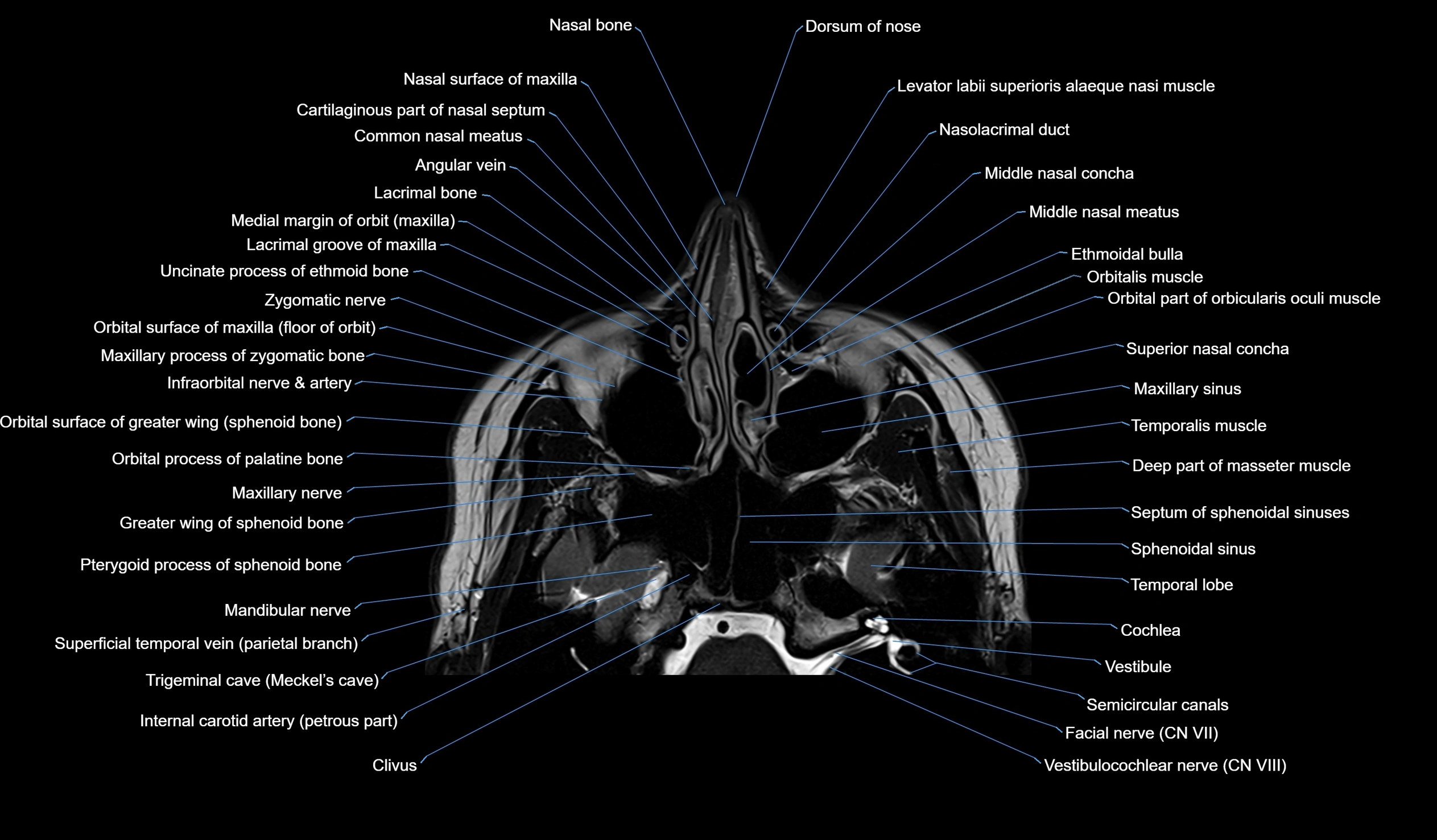 MRI face & paranasal sinuses(PNS) labelled  axial  cross sectional anatomy 3T radiology  image -00015.webp